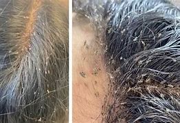 Mimpi Nyerit Rambut Dapat Kutu Banyak